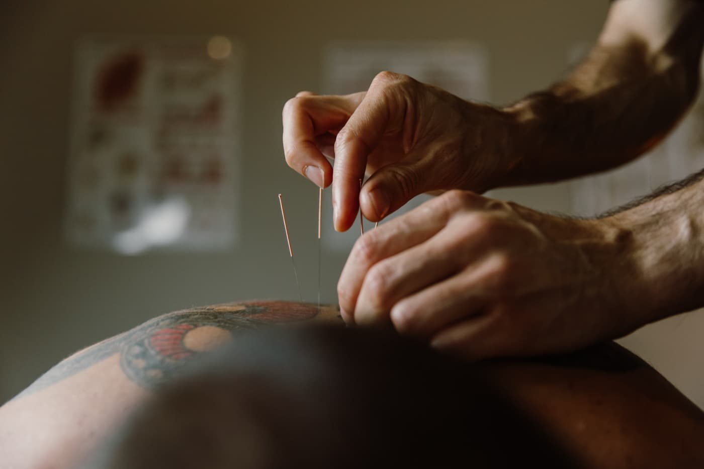 Dry Needling